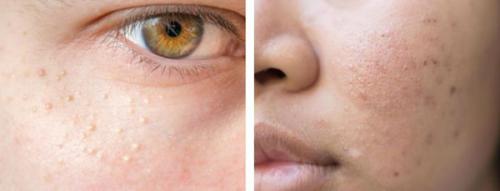 Как убрать пятна от прыщей на лице. Симптомы постакне 02