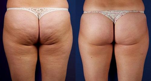 LPG массаж противопоказания. Когда нужен LPG массаж 05