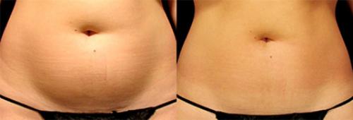 LPG массаж противопоказания. Когда нужен LPG массаж 04