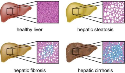 Что еще вызывает ожирение печени. Определение болезни. Причины заболевания 01 Что еще вызывает ожирение печени. Определение болезни. Причины заболевания 01