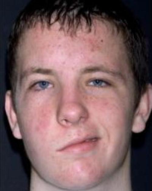 Что такое ботулотоксин и для чего делают инъекции бoтoкса. 03