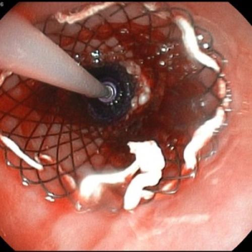 Питание для профилактики и лечения панкреатита. Что такое панкреатит 02 Питание для профилактики и лечения панкреатита. Что такое панкреатит 02