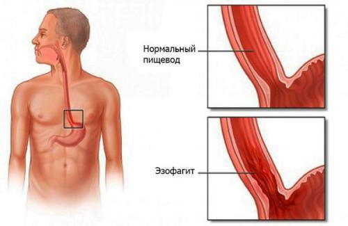 Как восстановить защитные свойства желудка.. Классификация и стадии развития атрофического гастрита 05 Как восстановить защитные свойства желудка.. Классификация и стадии развития атрофического гастрита 05