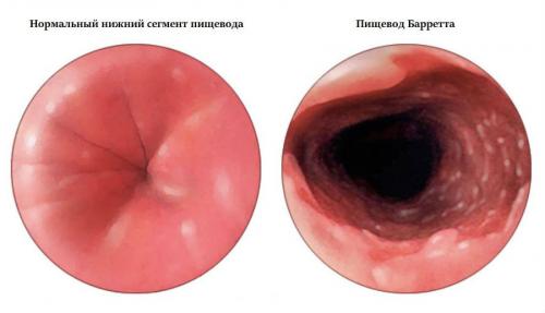 Как восстановить защитные свойства желудка.. Классификация и стадии развития атрофического гастрита 02 Как восстановить защитные свойства желудка.. Классификация и стадии развития атрофического гастрита 02