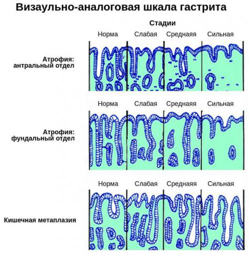 Как восстановить защитные свойства желудка.. Классификация и стадии развития атрофического гастрита 01 Как восстановить защитные свойства желудка.. Классификация и стадии развития атрофического гастрита 01