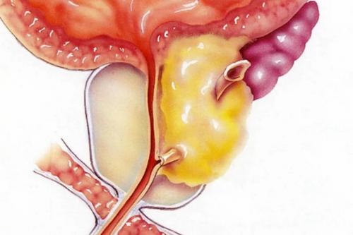 Чем снять боль при простатите. Воспаление простаты