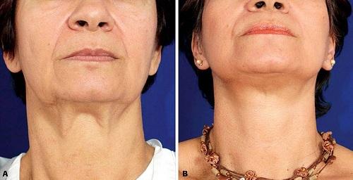 10 вопросов о ботулинотерапии. Механизм действия 02 10 вопросов о ботулинотерапии. Механизм действия 02