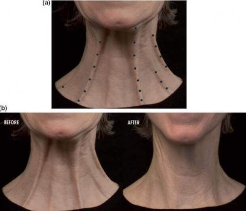 10 вопросов о ботулинотерапии. Механизм действия 01 10 вопросов о ботулинотерапии. Механизм действия 01