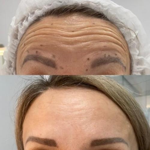 Первый ботокс: полное руководство для начинающих 01