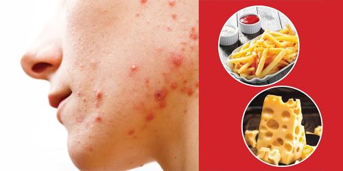 Что можно при акне. АКНЕ И ДИЕТА: МОЛОЧНЫЕ ПРОДУКТЫ, ЖИРЫ И УГЛЕВОДЫ
