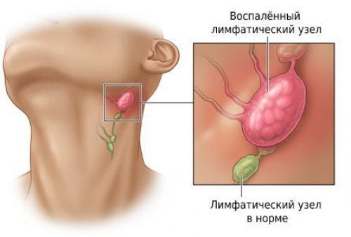 Почему воспаляются лимфоузлы на шее. Распознаем причины — не факт, что ангина 02 Почему воспаляются лимфоузлы на шее. Распознаем причины — не факт, что ангина 02