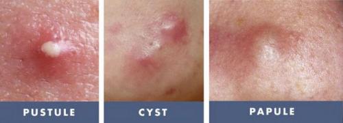 Как избавиться от пятен прыщей. Как избавиться от постакне: косметологические процедуры 02 Как избавиться от пятен прыщей. Как избавиться от постакне: косметологические процедуры 02