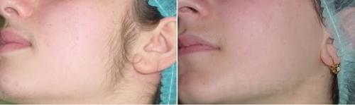 Как выпадают волосы после лазерной эпиляции. Отличия лазерной эпиляции от фотоэпиляции и других видов эпиляции? 02 Как выпадают волосы после лазерной эпиляции. Отличия лазерной эпиляции от фотоэпиляции и других видов эпиляции? 02