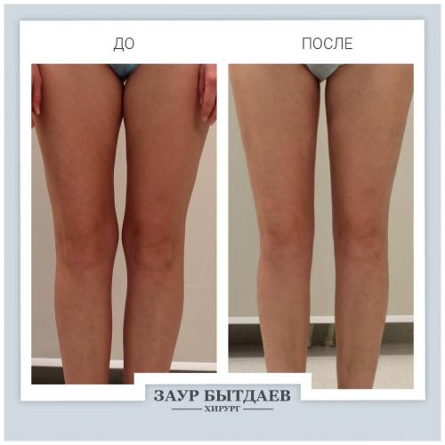 Плюсы и минусы липосакции. Лазерная липосакция: плюсы и минусы новых технологий