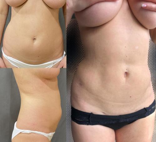 Липосакция краснодар. Липосакция в Краснодаре