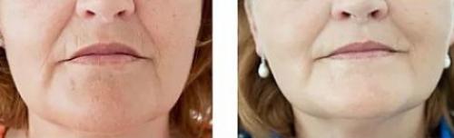 Мезотерапия с витамином с для лица. Как инъекции пептидов увеличивают содержание коллагена 01 Мезотерапия с витамином с для лица. Как инъекции пептидов увеличивают содержание коллагена 01