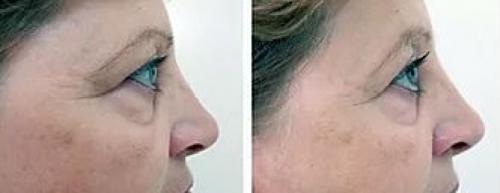 Мезотерапия с витамином с для лица. Как инъекции пептидов увеличивают содержание коллагена 02 Мезотерапия с витамином с для лица. Как инъекции пептидов увеличивают содержание коллагена 02