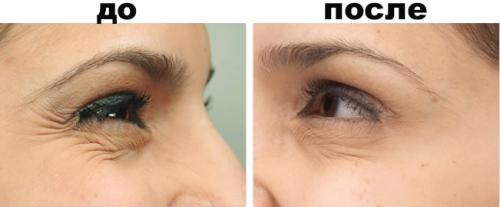 Гусиные лапки вокруг глаз, как избавиться косметология. Как убрать гусиные лапки вокруг глаз