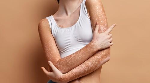 Чем осветлить пятна на руках. Пигментные пятна на руках: причины и как избавиться