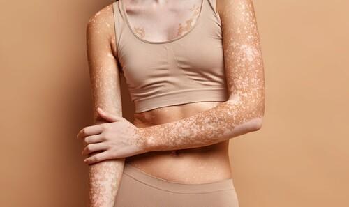 Чем осветлить пятна на руках. Пигментные пятна на руках: причины и как избавиться