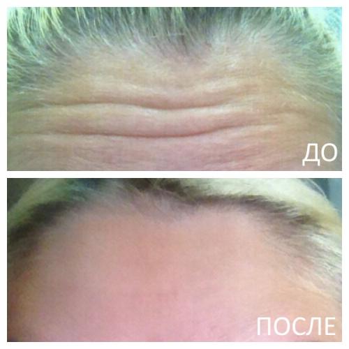 Через сколько дней ботокс начинает действовать на лбу после инъекции. Плюсы и минусы применения в косметологии 02