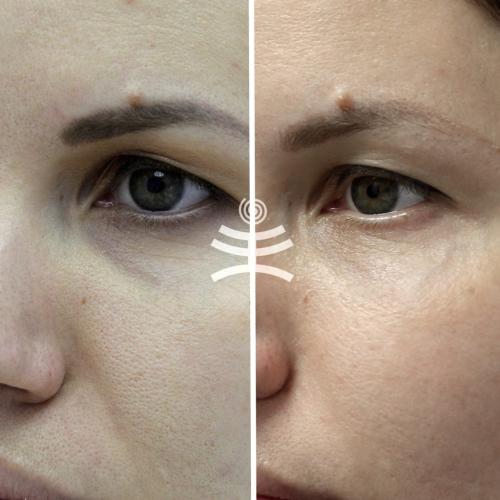 Маски для области вокруг глаз в домашних условиях. Все способы избавиться от морщин вокруг глаз