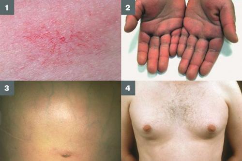 Алкогольная болезнь печени неуточненная. Краткое описание 02 Алкогольная болезнь печени неуточненная. Краткое описание 02