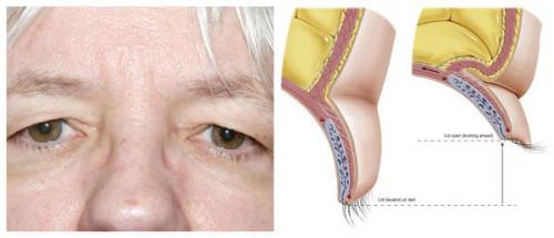 Как убрать складку на веке верхнем. Пластика верхнего века 04