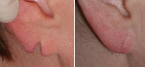 Как вернуть молодость мочкам ушей. Коррекция мочки уха 04