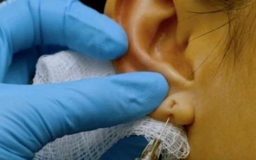 Как вернуть молодость мочкам ушей. Коррекция мочки уха 03