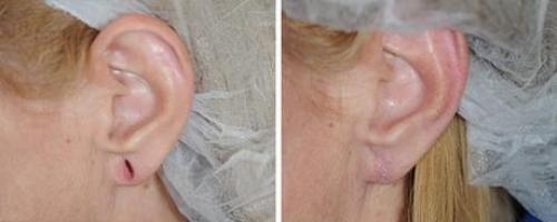 Как вернуть молодость мочкам ушей. Коррекция мочки уха 02