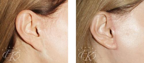 Как вернуть молодость мочкам ушей. Коррекция мочки уха 08