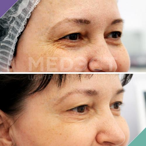 Морщины вокруг глаз, как убрать. Все способы избавиться от морщин вокруг глаз