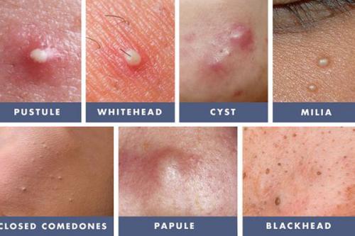 Как восстановить кожу лица после прыщей. Чистая кожа раз и навсегда! Как победить акне? 01 Как восстановить кожу лица после прыщей. Чистая кожа раз и навсегда! Как победить акне? 01