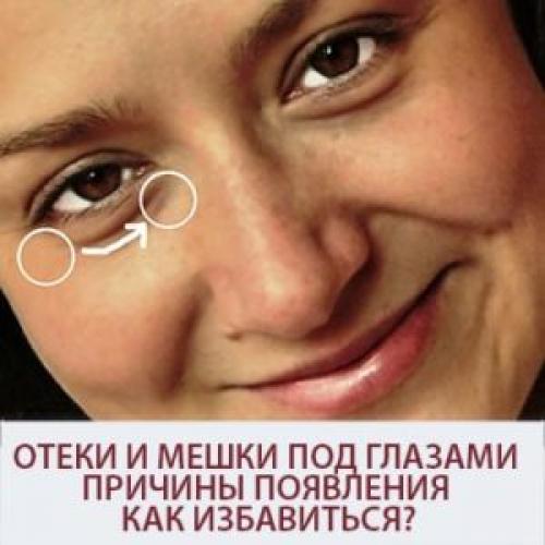 Можно ли устранить мешки и темные круги под глазами с помощью домашних средств. Отеки и мешки под глазами. Причины появления. Как избавиться?