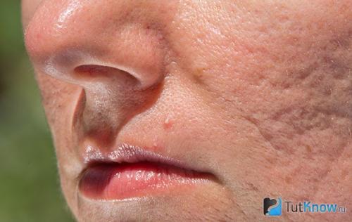 Секреты удаления прыщей: проверенные методы для домашнего использования 06