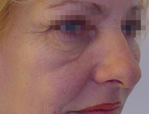 Убрать темные круги под глазами у косметолога. Вопрос: Малярные мешки.