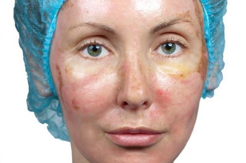 Ретиноевый пилинг для лица. Пилинг лица ретиноевый 07 Ретиноевый пилинг для лица. Пилинг лица ретиноевый 07