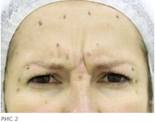 Ботокс под глаза и в уголки глаз в Москве. Ботокс вокруг глаз 02