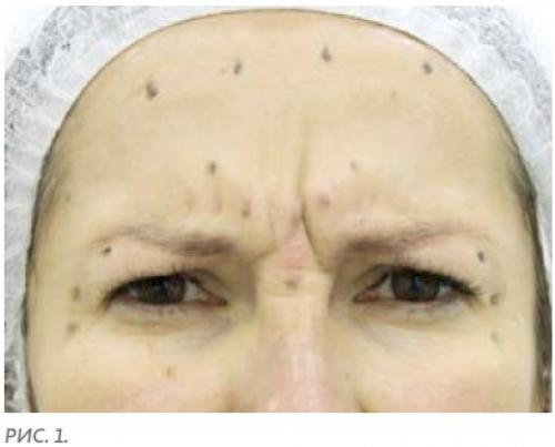 Ботокс под глаза и в уголки глаз в Москве. Ботокс вокруг глаз 01