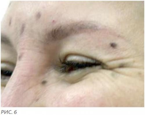 Ботокс под глаза и в уголки глаз в Москве. Ботокс вокруг глаз 06