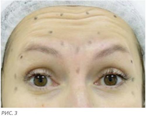 Ботокс под глаза и в уголки глаз в Москве. Ботокс вокруг глаз 03