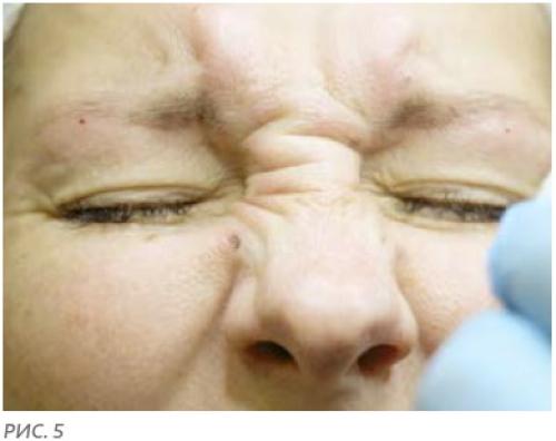 Ботокс под глаза и в уголки глаз в Москве. Ботокс вокруг глаз 05