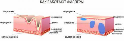 Ботокс для лица последствия. Ботулинотерапия в косметологии 02 Ботокс для лица последствия. Ботулинотерапия в косметологии 02