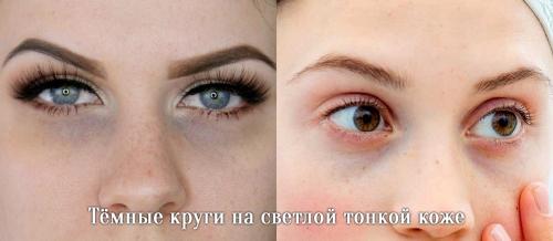Убрать темные круги под глазами у косметолога. Давайте взглянем на анатомическое строение области глаз.