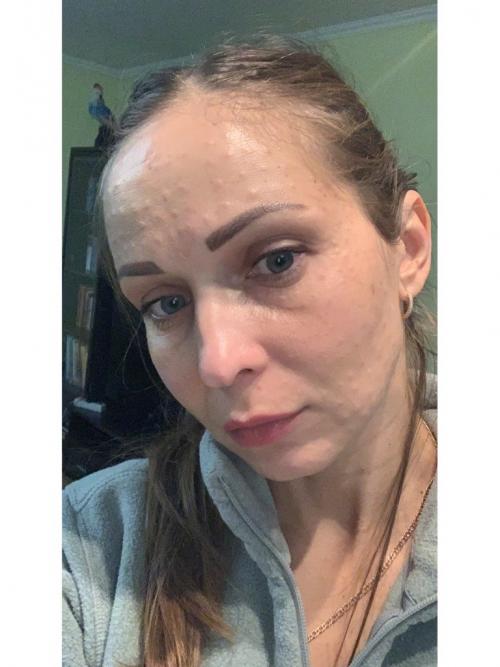 Почему не рассасываются папулы после биоревитализации. Папулы после биоревитализации: когда они проходят? 03 Почему не рассасываются папулы после биоревитализации. Папулы после биоревитализации: когда они проходят? 03