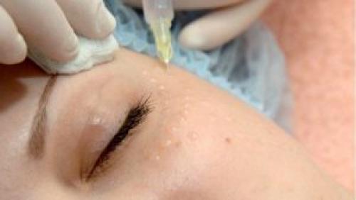 Как убрать морщины под глазами косметология инъекции. Какие препараты от кругов (синяков) под глазами можно использовать? 01