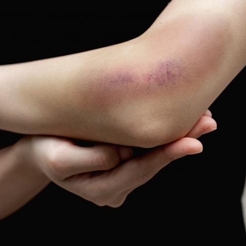 Как скрыть прыщи на лице за 5 минут без косметики в домашних условиях. Чем мазать синяк