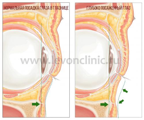 Как избавиться от темных кругов под глазами косметология. Давайте взглянем на анатомическое строение области глаз.
