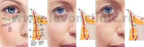 Как избавиться от темных кругов под глазами косметология. Давайте взглянем на анатомическое строение области глаз.